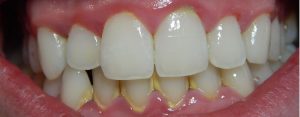 Close up of teeth showing signs of gingivitis