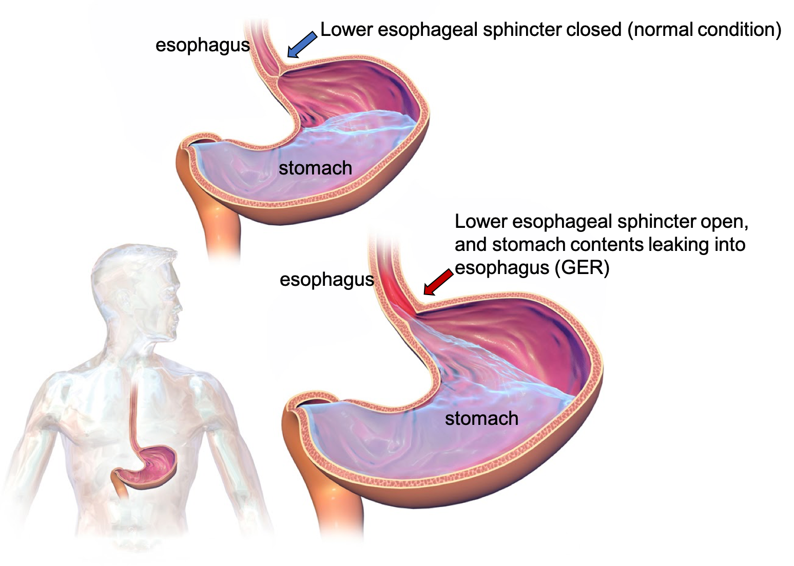 The illustration shows a silhouette of a person, with the esophagus and stomach highlighted, at bottom left. At top, a normal stomach is shown, with the lower esophageal sphincter closed and the stomach contents fully contained in the stomach. At lower right, a stomach is shown with GER; the lower esophageal sphincter is open and the stomach context are leaking into the esophagus.