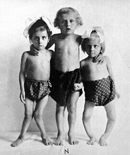 A black-and-white photograph shows three children with rickets, each with legs deformed to varying degrees. The child on the left has legs that bow inwards, her knees touching. The child on the right has legs that are bowed, with knees far apart.