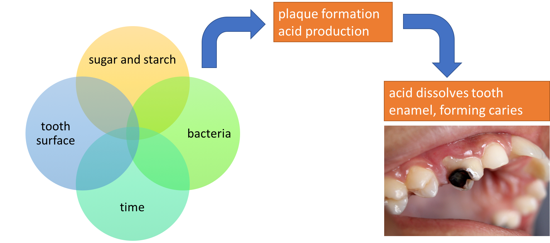 The image is a schematic. On the left, it shows a Venn diagram with four circles coming together, with the words "tooth surface," "sugar and starch," "bacteria," and "time." When these 4 factors are present, the schematic shows that it results in plaque formation and acid production. This then leads to acid dissolving tooth enamel, forming dental caries. A photo shows a tooth with a severe cavity, with half of the tooth blackened.